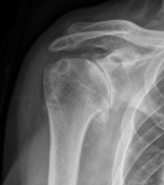 Αρθρίτιδα ώμου