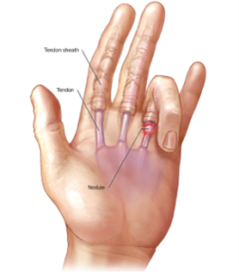 Εκτινασσόμενος δάκτυλος (Τrigger finger)